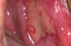 Oral infections