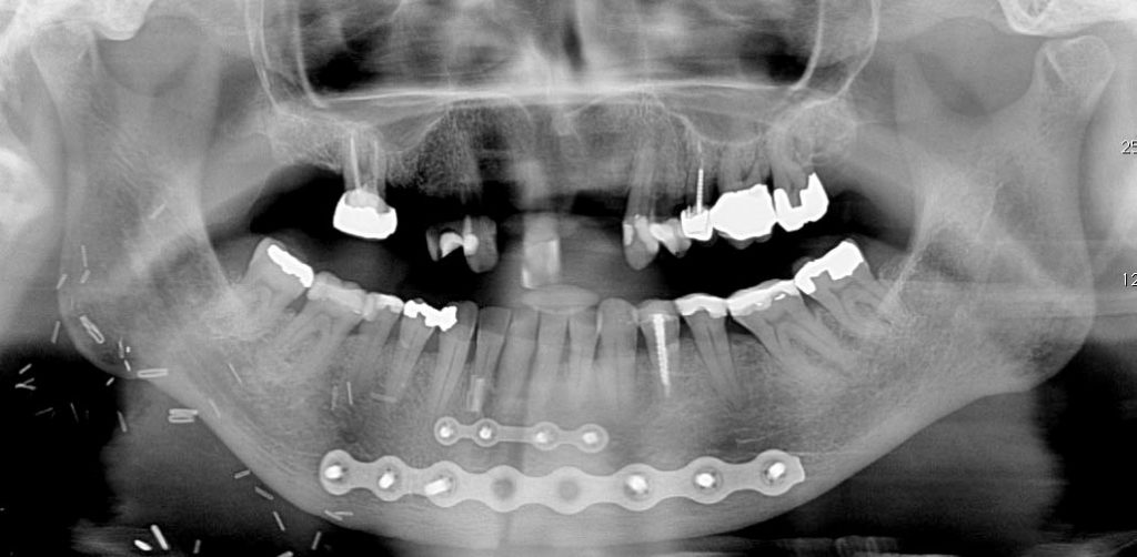 Photo of A surgical procedure, mandibulotomy involves splitting the mandible to gain access to the floor of mouth and tongue.