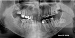 Post Radiation Caries Example