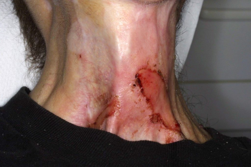 Figure 3: Typically the skin starts to become erythematous and sore several days into treatment. The reaction may become more severe during the treatment and for up to about one week following the end of radiotherapy, and the skin may break down. Although this moist desquamation is uncomfortable, recovery is usually quick. Skin reactions tend to be worse in areas where there are natural folds in the skin, such as underneath the female breast, behind the ear, and in the groin.