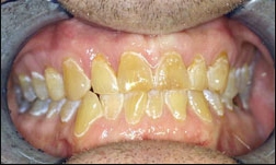Post Radiation Caries Example